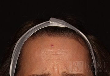BOTOX® Cosmetic Before - Paramus, NJ BOTOX® Cosmetic Before - Paramus, NJ