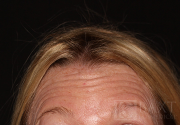 BOTOX® Cosmetic Before - Paramus, NJ BOTOX® Cosmetic Before - Paramus, NJ