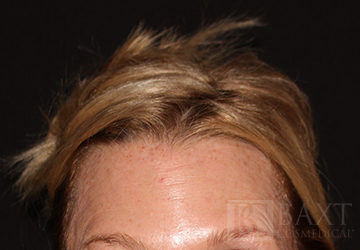 BOTOX® Cosmetic After - Paramus, NJ BOTOX® Cosmetic After - Paramus, NJ