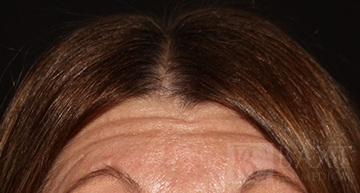 BOTOX® Cosmetic Before - Paramus, NJ BOTOX® Cosmetic Before - Paramus, NJ