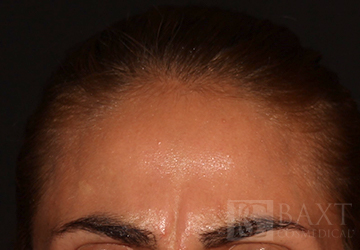 BOTOX® Cosmetic Before - Paramus, NJ BOTOX® Cosmetic Before - Paramus, NJ