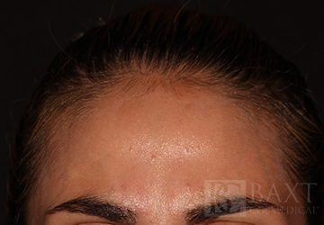 BOTOX® Cosmetic After - Paramus, NJ BOTOX® Cosmetic After - Paramus, NJ