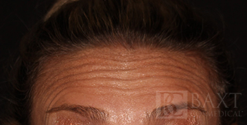 BOTOX® Cosmetic Before - Paramus, NJ