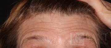 BOTOX® Cosmetic Before - Paramus, NJ BOTOX® Cosmetic Before - Paramus, NJ