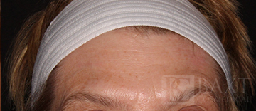 BOTOX® Cosmetic After - Paramus, NJ BOTOX® Cosmetic After - Paramus, NJ
