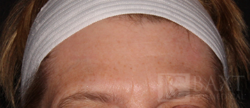 BOTOX® Cosmetic After - Paramus, NJ BOTOX® Cosmetic After - Paramus, NJ