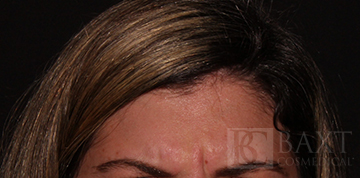 BOTOX® Cosmetic Before - Paramus, NJ BOTOX® Cosmetic Before - Paramus, NJ