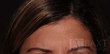 BOTOX® Cosmetic After - Paramus, NJ BOTOX® Cosmetic After - Paramus, NJ