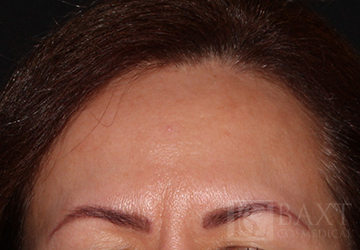 BOTOX® Cosmetic Before - Paramus, NJ BOTOX® Cosmetic Before - Paramus, NJ