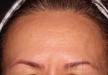 BOTOX® Cosmetic After - Paramus, NJ BOTOX® Cosmetic After - Paramus, NJ