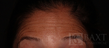 BOTOX® Cosmetic Before - Paramus, NJ BOTOX® Cosmetic Before - Paramus, NJ