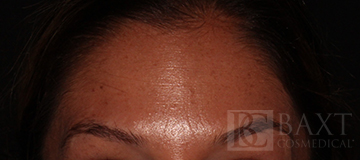 BOTOX® Cosmetic After - Paramus, NJ BOTOX® Cosmetic After - Paramus, NJ
