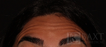 BOTOX® Cosmetic Before - Paramus, NJ BOTOX® Cosmetic Before - Paramus, NJ