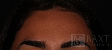 BOTOX® Cosmetic After - Paramus, NJ BOTOX® Cosmetic After - Paramus, NJ