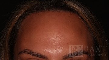 BOTOX® Cosmetic After - Paramus, NJ BOTOX® Cosmetic After - Paramus, NJ