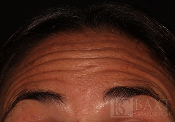 BOTOX® Cosmetic Before - Paramus, NJ BOTOX® Cosmetic Before - Paramus, NJ