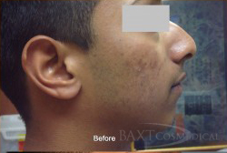 Chemical Peels Before - Paramus, NJ Chemical Peels Before - Paramus, NJ