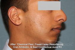 Chemical Peels After - Paramus, NJ Chemical Peels After - Paramus, NJ