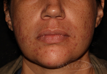 Chemical Peels Before - Paramus, NJ Chemical Peels Before - Paramus, NJ