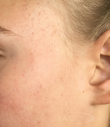 Chemical Peels After - Paramus, NJ Chemical Peels After - Paramus, NJ