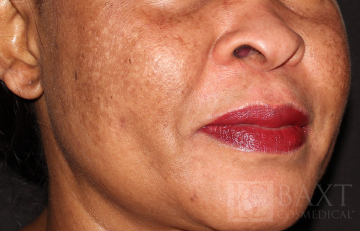 Chemical Peels Before - Paramus, NJ
