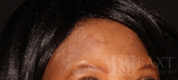 Chemical Peels After - Paramus, NJ