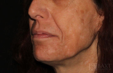 Chemical Peels Before - Paramus, NJ