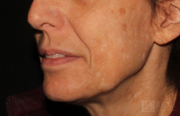 Chemical Peels After - Paramus, NJ