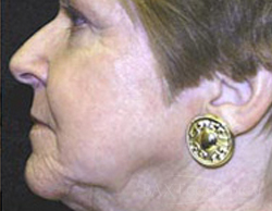 CO2 Laser Resurfacing After CO2 Laser Resurfacing After