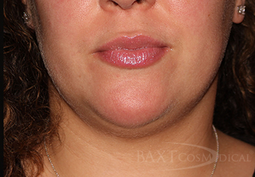 CoolSculpting® Treatment Before - Paramus, NJ CoolSculpting® Treatment Before - Paramus, NJ