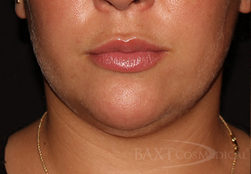 CoolSculpting® Treatment After - Paramus, NJ CoolSculpting® Treatment After - Paramus, NJ