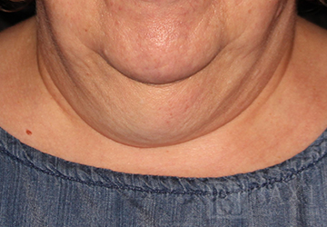 CoolSculpting® Treatment Before - Paramus, NJ