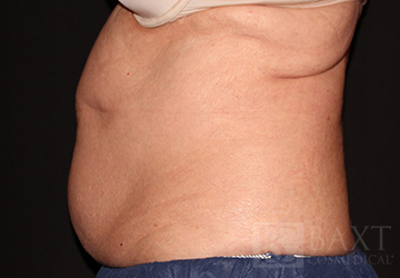 CoolSculpting® Treatment Before - Paramus, NJ CoolSculpting® Treatment Before - Paramus, NJ