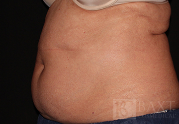 CoolSculpting® Treatment Before - Paramus, NJ CoolSculpting® Treatment Before - Paramus, NJ