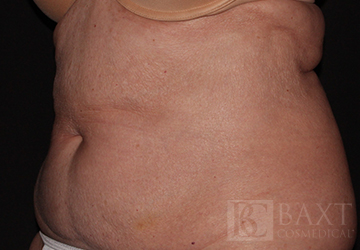 CoolSculpting® Treatment After - Paramus, NJ CoolSculpting® Treatment After - Paramus, NJ