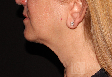 CoolSculpting® Treatment After - Paramus, NJ CoolSculpting® Treatment After - Paramus, NJ