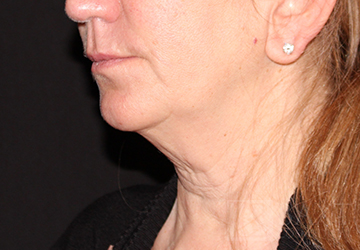 CoolSculpting® Treatment Before - Paramus, NJ CoolSculpting® Treatment Before - Paramus, NJ