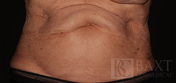 CoolSculpting® Treatment Before - Paramus, NJ CoolSculpting® Treatment Before - Paramus, NJ