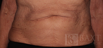 CoolSculpting® Treatment After - Paramus, NJ CoolSculpting® Treatment After - Paramus, NJ
