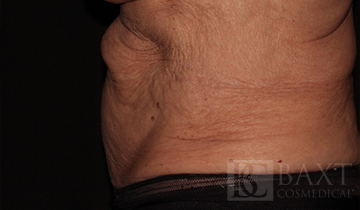 CoolSculpting® Treatment Before - Paramus, NJ CoolSculpting® Treatment Before - Paramus, NJ