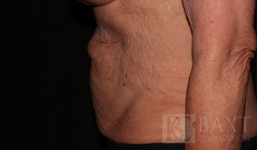 CoolSculpting® Treatment After - Paramus, NJ CoolSculpting® Treatment After - Paramus, NJ