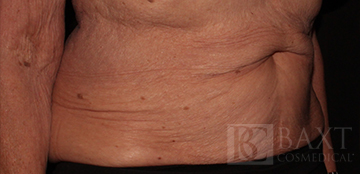 CoolSculpting® Treatment After - Paramus, NJ CoolSculpting® Treatment After - Paramus, NJ