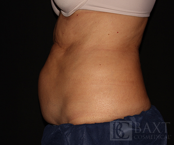 CoolSculpting® Treatment Before - Paramus, NJ CoolSculpting® Treatment Before - Paramus, NJ