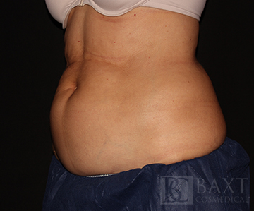 CoolSculpting® Treatment Before - Paramus, NJ CoolSculpting® Treatment Before - Paramus, NJ