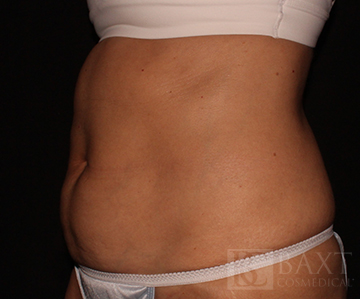 CoolSculpting® Treatment After - Paramus, NJ CoolSculpting® Treatment After - Paramus, NJ