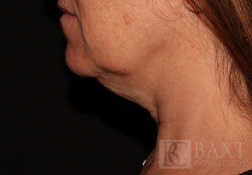 CoolSculpting® Treatment Before - Paramus, NJ CoolSculpting® Treatment Before - Paramus, NJ