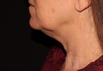 CoolSculpting® Treatment After - Paramus, NJ CoolSculpting® Treatment After - Paramus, NJ