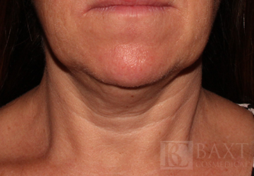 CoolSculpting® Treatment Before - Paramus, NJ CoolSculpting® Treatment Before - Paramus, NJ