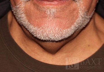 CoolSculpting® Treatment Before - Paramus, NJ CoolSculpting® Treatment Before - Paramus, NJ