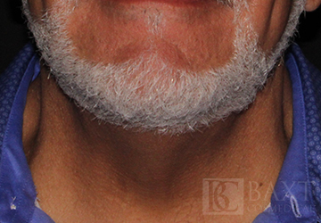 CoolSculpting® Treatment After - Paramus, NJ CoolSculpting® Treatment After - Paramus, NJ